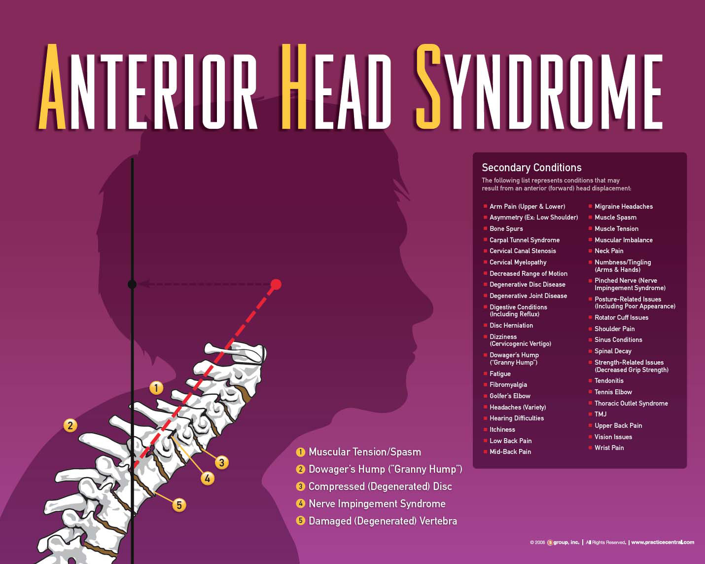 A graphic representation of Anterior Head Syndrome.